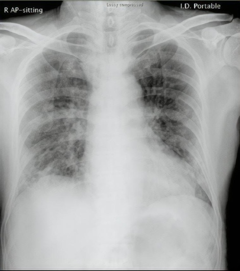 Chest X-ray image in AP sitting position