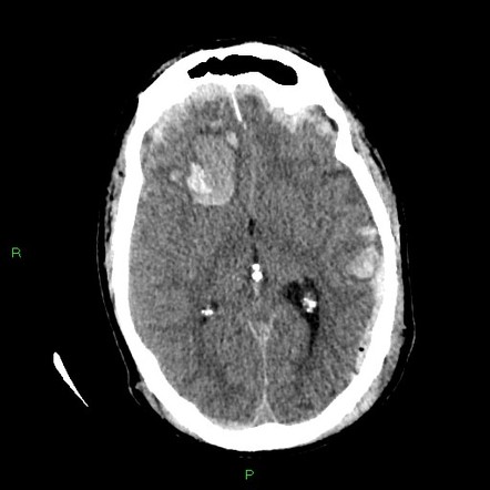 Medical brain CT scan image showing anatomical structures in grayscale