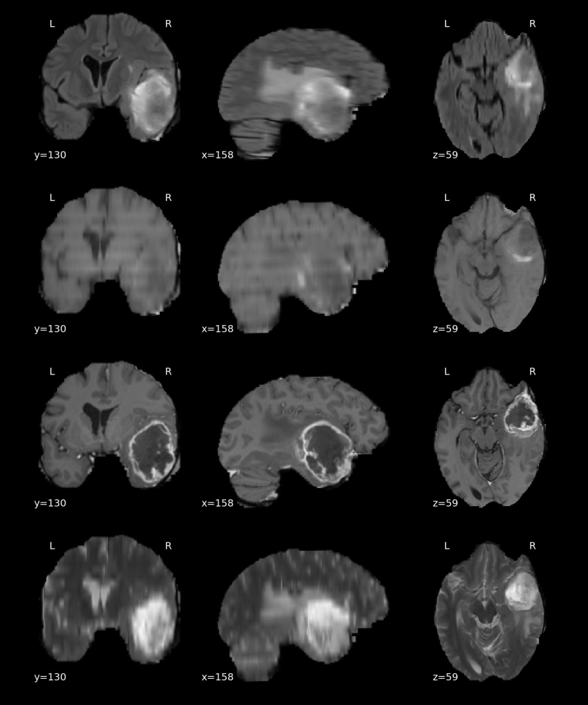 Figure 1. Multi-modality tumor dataset BraTS. From top to bottom: T2-FLAIR, T1, T1Gd, and T2-weighted. All four modalities provide complementary information for identifying tumor regions. Case BraTS_001.