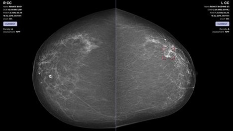 Vara's AI interface analyzing a mammogram for signs of cancer