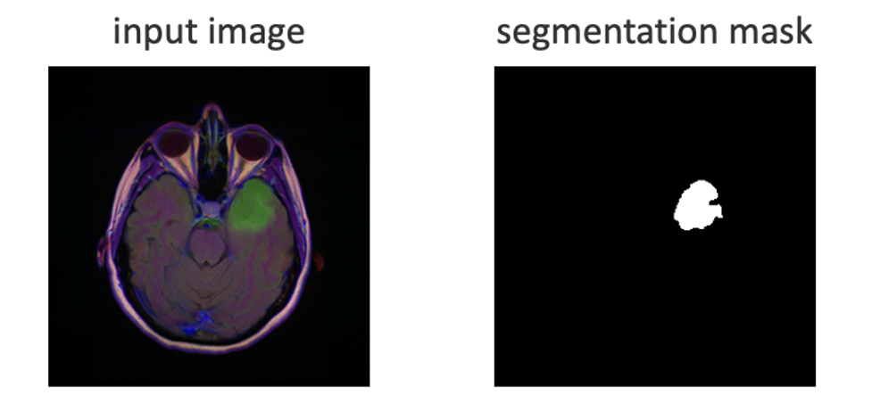 Figure 1 - Input datum represented by an enhanced MRI image and matching mask of the lesion area.