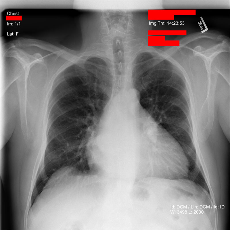 De-identifying medical images using Amazon Comprehend Medical and Amazon Rekognition 2